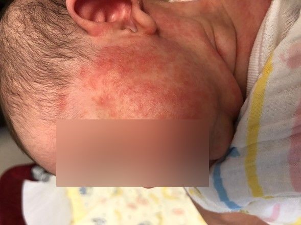 Rash